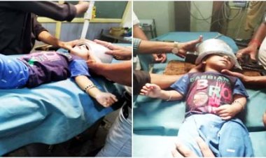 आगरा : खेल-खेल में मासूम के सिर में फंसा प्रेशर कुकर, सर्जन ने ऑपरेशन थिएटर में कटर मशीन से कटवाया
