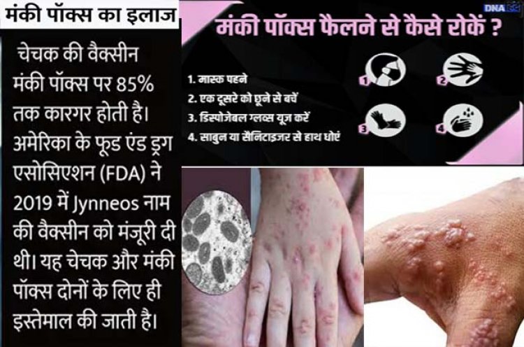मंकीपॉक्स को लेकर अलर्ट के बाद बढ़ रहे डॉक्टरों से संपर्क के मामले : SGPGI, KGMU समेत सभी चिकित्सा संस्थानों में जारी हुआ अलर्ट