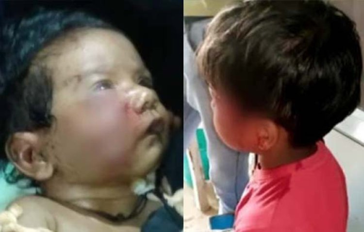 उत्तर प्रदेश के टूंडला क्षेत्र में बंदरों का आतंक : बंदरों ने दो बच्चों पर किया हमला, मासूमों के चेहरों को बुरी तरह काटा